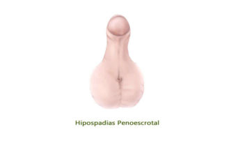 Diferencias entre hipospadias-penoescrotal y peneana