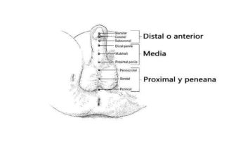 Hipospadia proximal peneana
