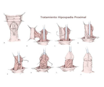 Hipospadia proximal tratamiento