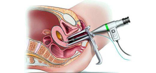 histeroscopia diagnostica