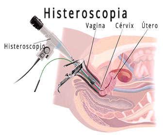 pruebas de infertilidad con histeroscopia